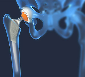 hip replacement surgery medical image