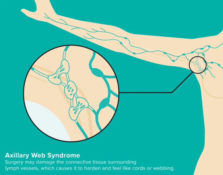 The Lymph Clinic - Axillary Web Syndrome or Cording. What is it? 🤔 This is  a condition that sometimes happens after breast cancer surgery, usually  after dissecting lymph nodes. Surgery may damage
