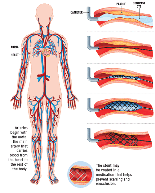 Clearing Clogged Arteries To Protect Your Heart RWJ University 