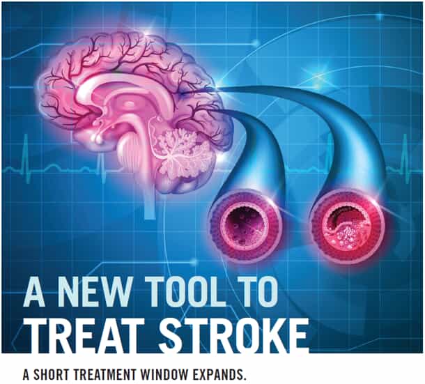 A New Tool To Treat Stroke