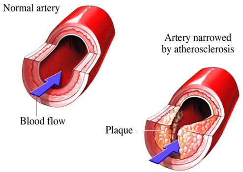 atherosclerosis process