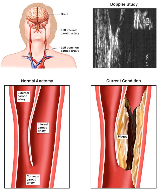 What Is Carotid Artery Disease 