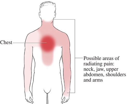 chest pain location chart