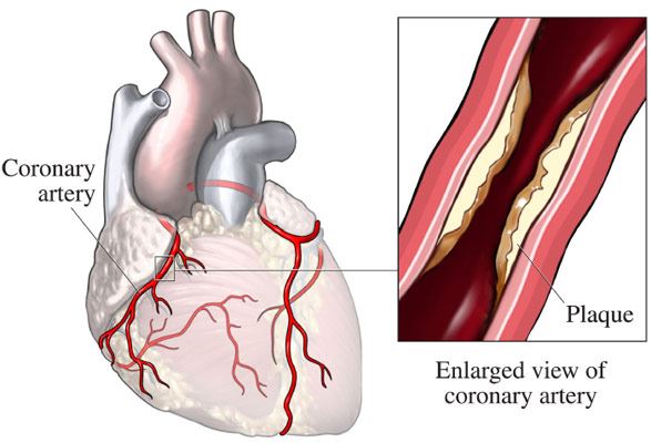 coronary artery disease treatment