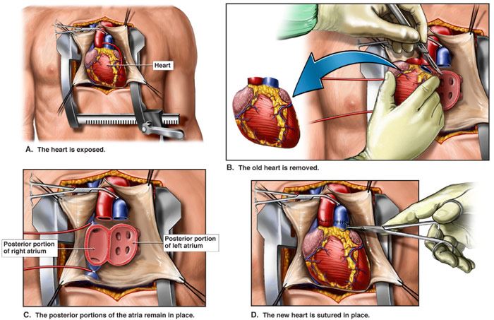 Heart Transplants In New Jersey RWJBarnabas Health