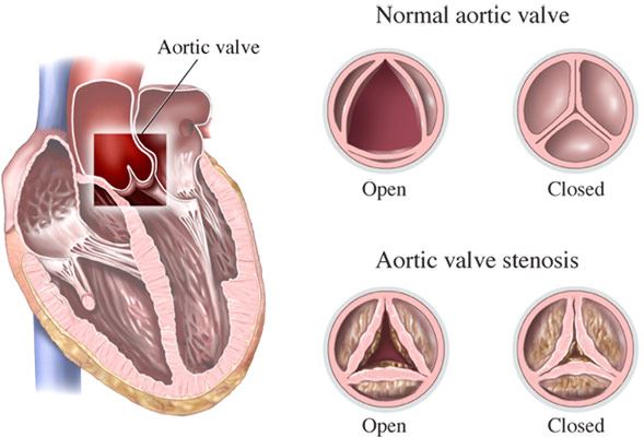 Heart Valve Disease Treatment In New Jersey