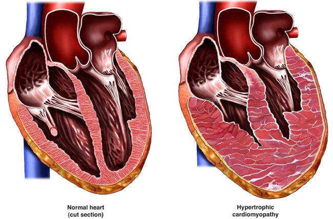 Inherited Cardiovascular Disease Diagnosis Symptoms And Treatment