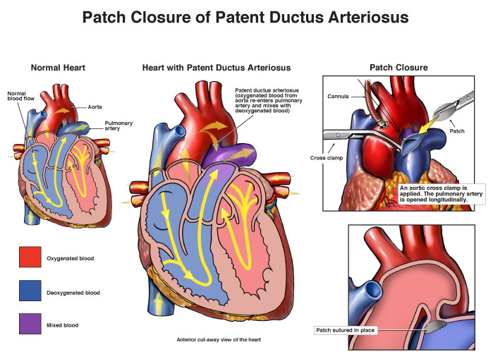 Patent Ductus Arteriosus Surgery | Heart Surgery in New Jersey