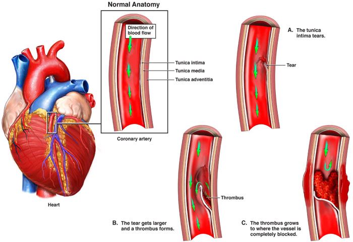 Spontaneous Coronary Artery Dissection Treatment