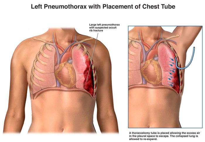 chest tube insertion new england journal of medicine