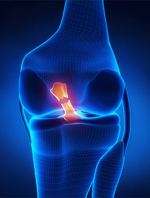ACL tear treatment without surgery
