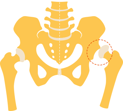 illustration of hip dysplasia